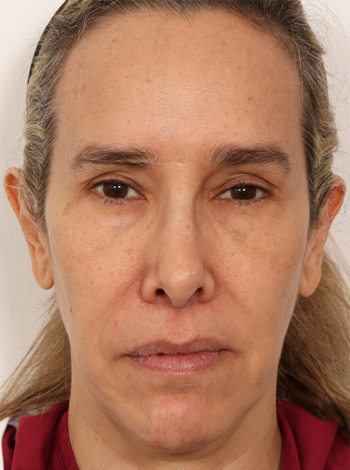 Latmman-Brow Lift-Result1
