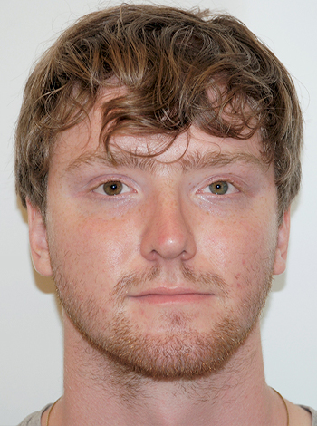 Latmman-Ptosis Result2