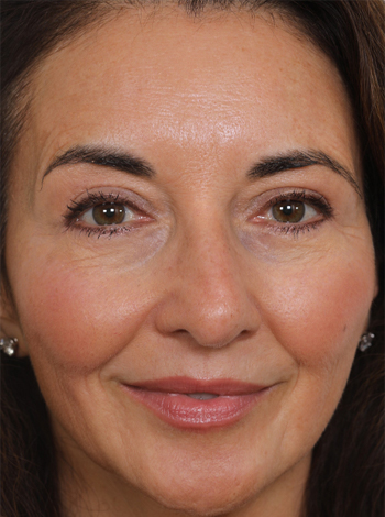 Lattman-Lower-Bleph2