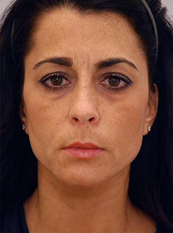 Lattman-Lower-Bleph3