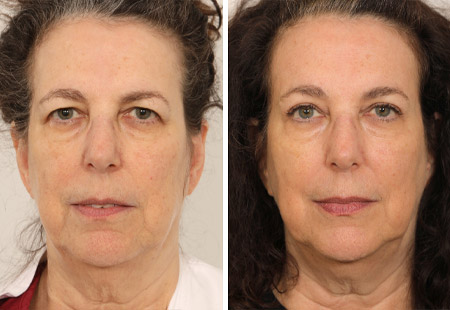 Case Study – Endoscopic Brow Lift and Upper Lid Blepharoplasty