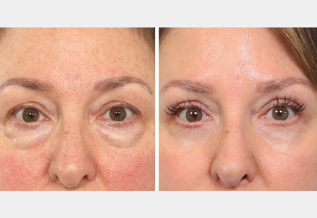 Under Eye Bags – Case Study