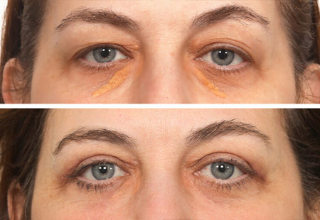 Xanthelasma – What is it and what can I do about it? – What is it and what can I do about it?