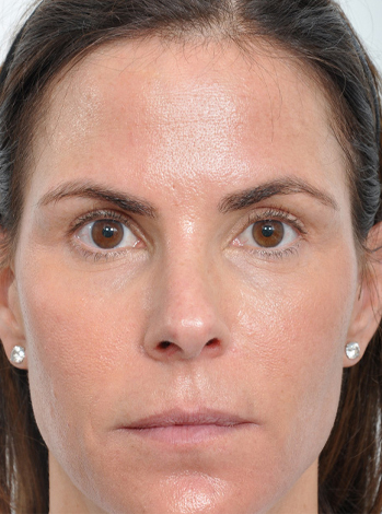 Lattman-Browlift Result1