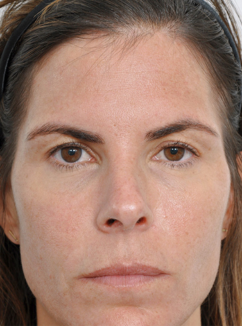 Lattman-Browlift Result2