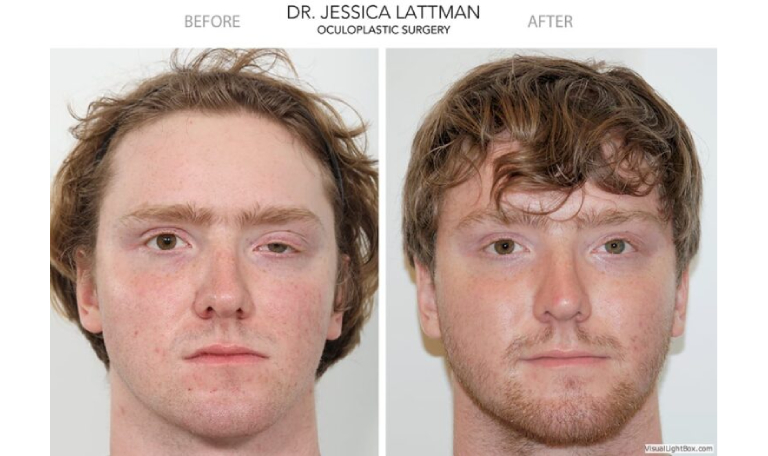 before and after ptosis repair front view male patient case 4