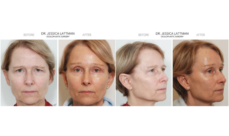 before and after eyelid lift female patient front and angle view