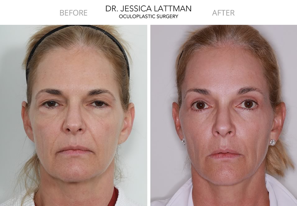 Case Study: Upper and Lower Eyelid Blepharoplasty and Endoscopic Brow Lift