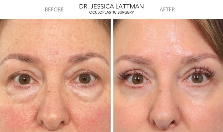 before and after blepharoplasty under eye female patient case 2808