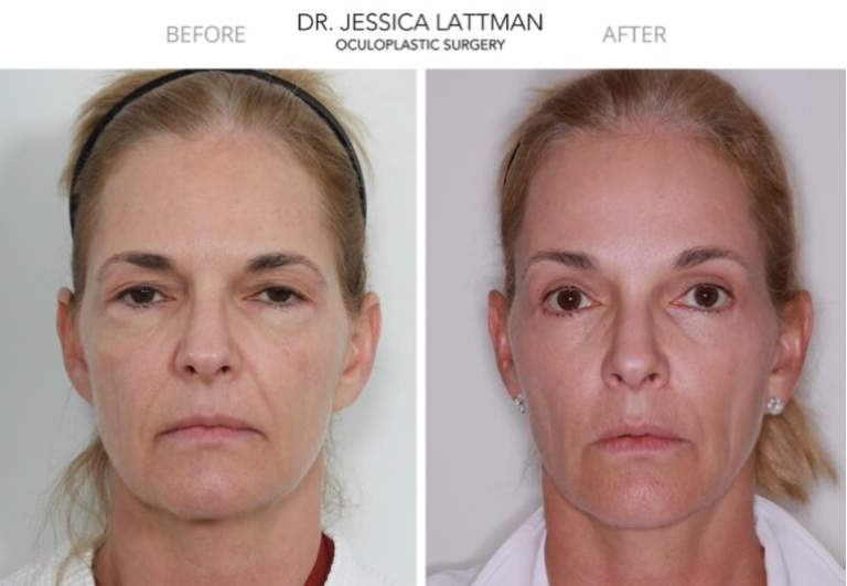 blepharoplasty female patient front view case 1