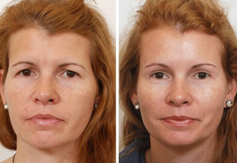 before and after brow lift front view female patient
