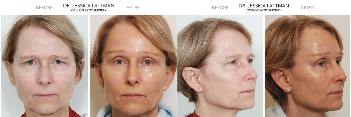 Case Study Upper Eyelid Blepharoplasty and Endoscopic Browlift