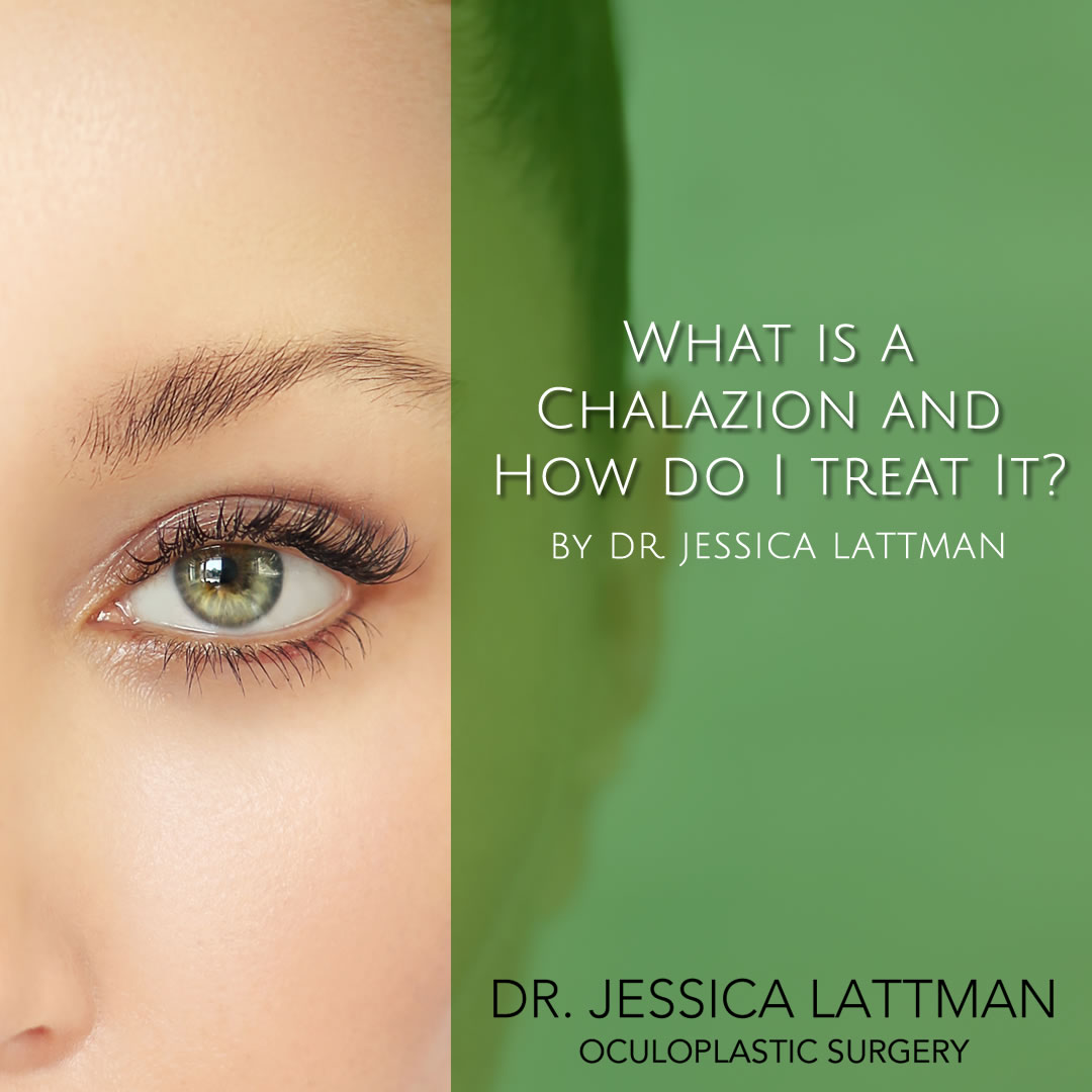 What is a Chalazion and how do I treat it?