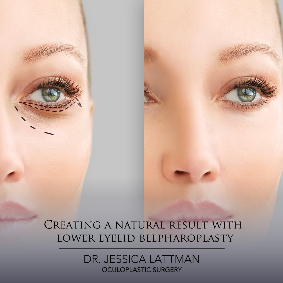 Creating A Natural Result With Lower Eyelid Blepharoplasty