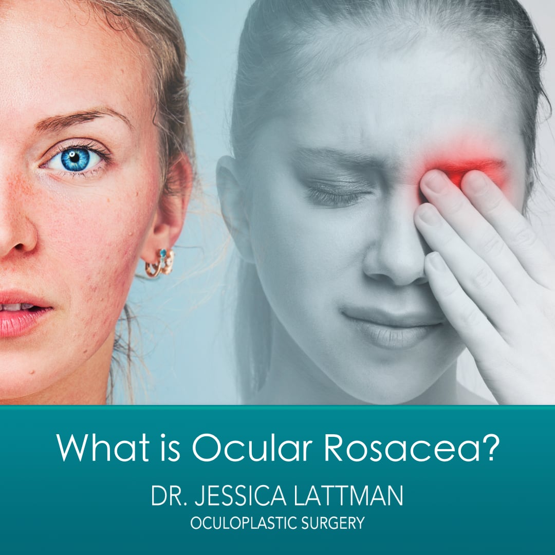 What Is Ocular Rosacea?