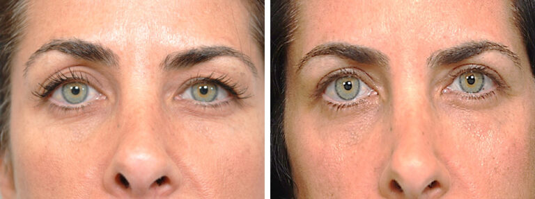 before and after Blepharoplasty and Ptosis Repair female patient front view Dr. Lattman