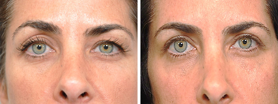 before and after Blepharoplasty and Ptosis Repair female patient front view Dr. Lattman