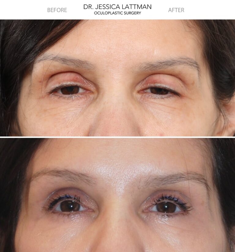 ptosis repair female patient case 3