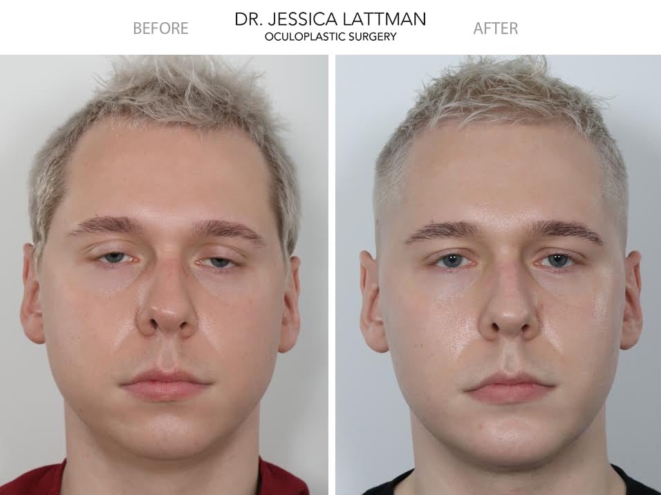 Droopy Eyelids Ptosis – Case Study