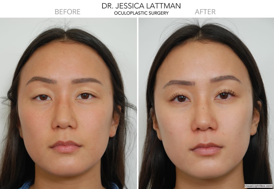 Case Study – Eyelid Asymmetry