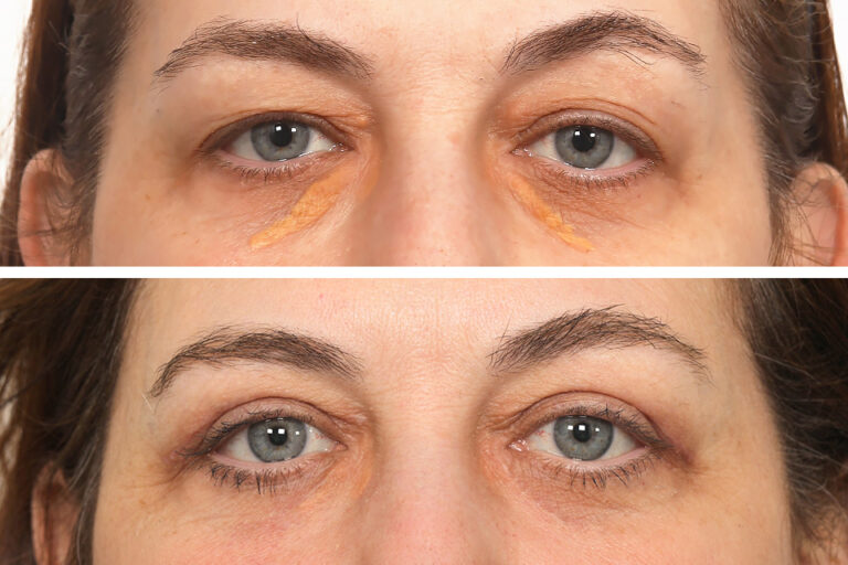 before and after Xanthelasma excision and Blepharoplasty female patient case 4089