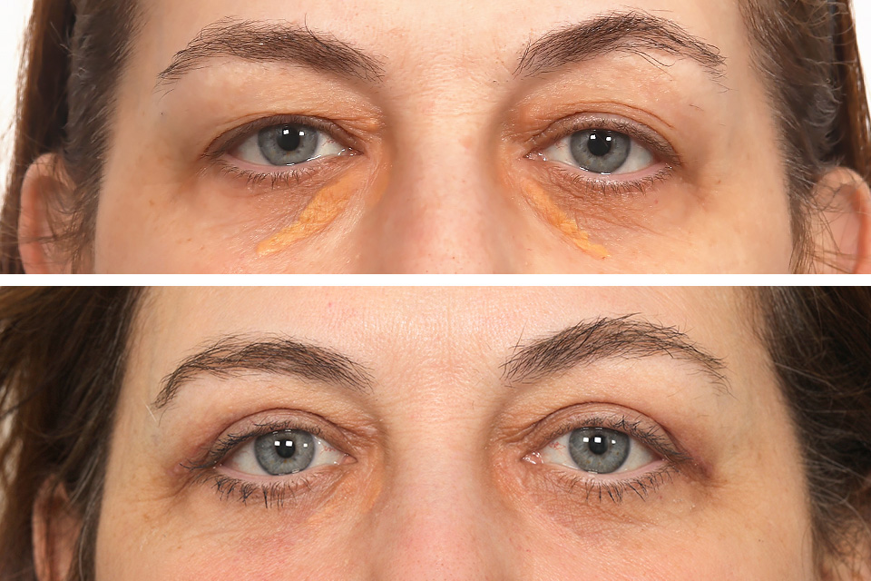 before and after Xanthelasma excision and Blepharoplasty female patient case 4089