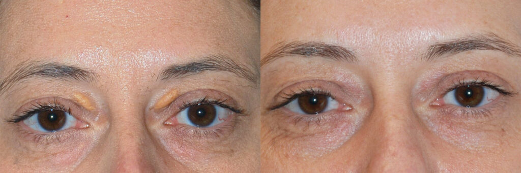 before and after xanthelasma case 4314 NYC