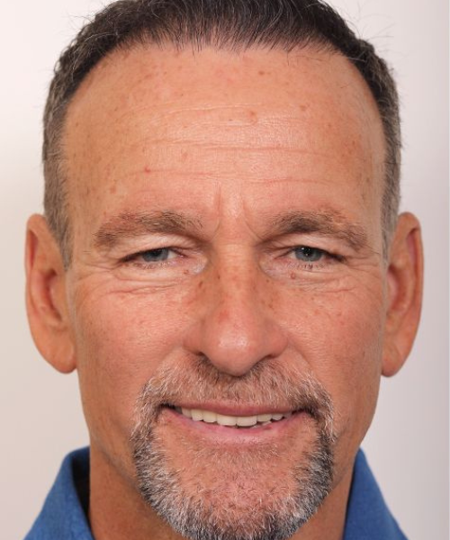 Blepharoplasty and Brow Lift Case 1.1