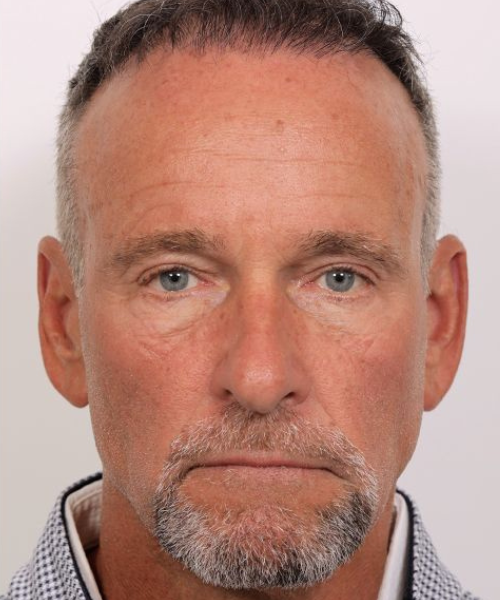 Blepharoplasty and Brow Lift Case 1.2 (1)