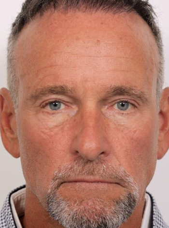 Blepharoplasty and Brow Lift Case 1.2 (3)