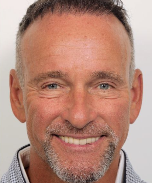 Blepharoplasty and Brow Lift Case 1.2