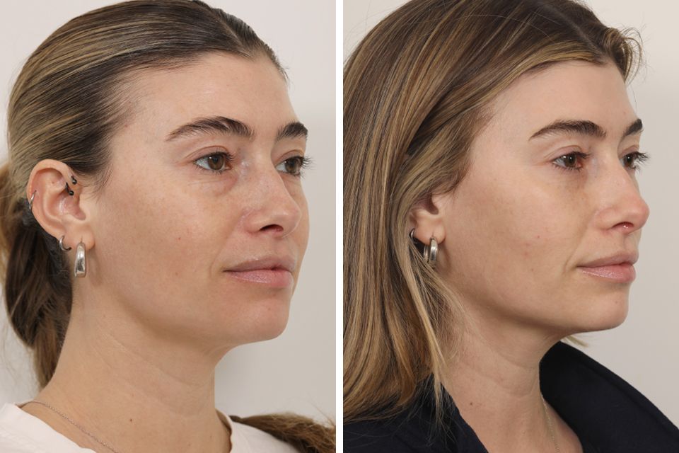 blepharoplasty-facial-fat-grafting--5145